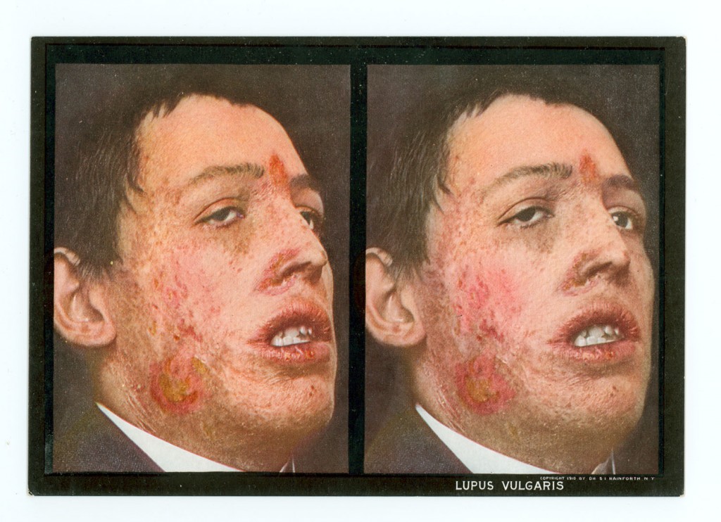 S. I. Rainforth. The stereoscopic skin clinic; an atlas of diseases of the skin, consisting of colored stereoscopic illustrations and a text in the form of clinical lectures, designed for the use of practitioners and students of medicine. New York: Medical Art Pub. Co., 1914.